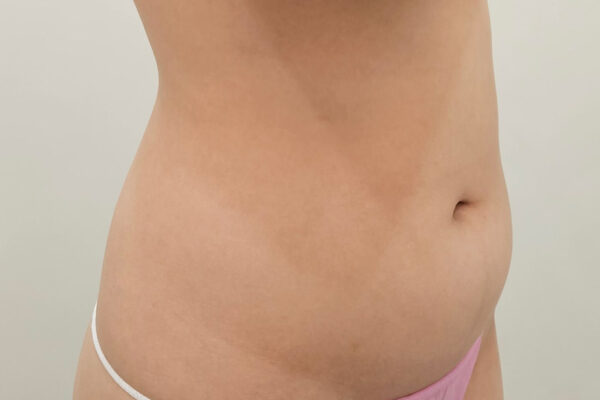 Before Surgery