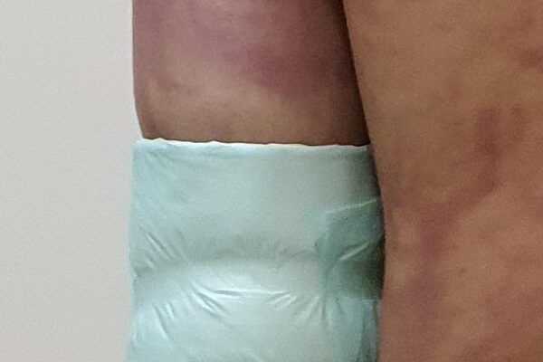 Day of Surgery