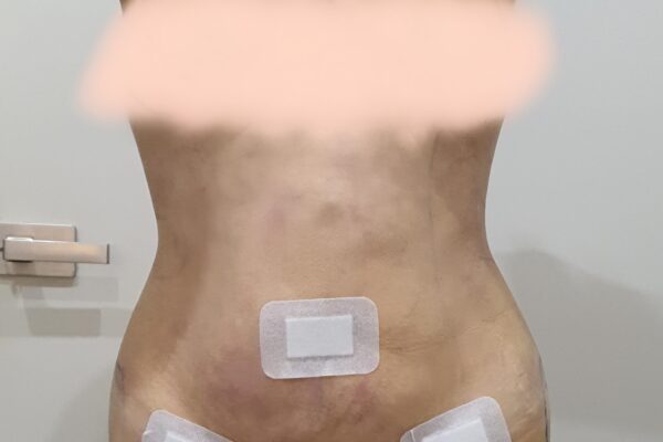 Day of Surgery